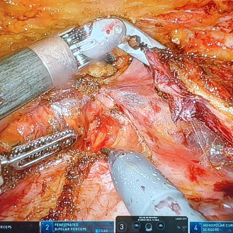 Abdominal wall surgery in the operating room