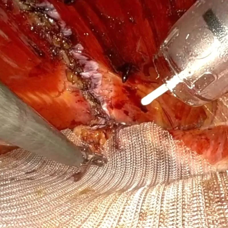 Preparation of the abdominal wall during surgery