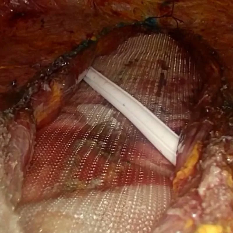 Intraoperative detail of the reconstruction of the abdominal wall
