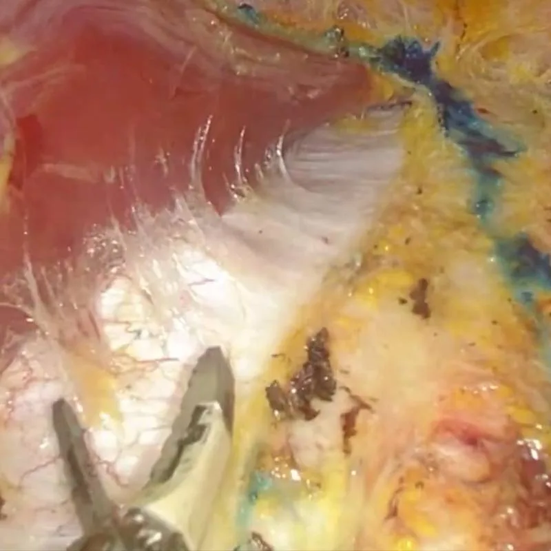 Reconstruction of the abdominal wall with a mesh