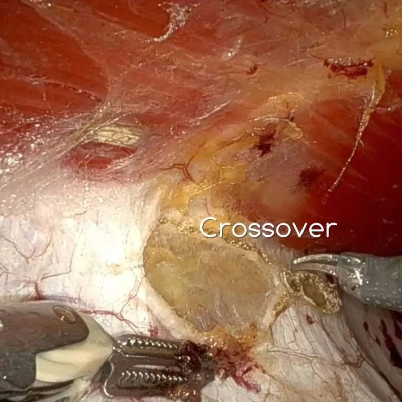 Reconstructive surgery of the abdominal wall