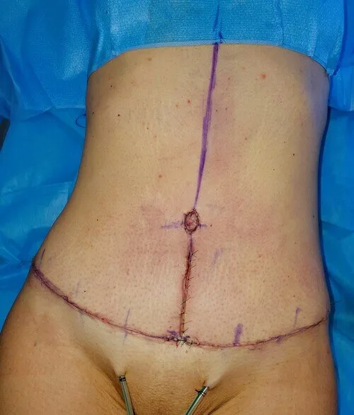 T-shaped abdominal scar after abdominal wall surgery