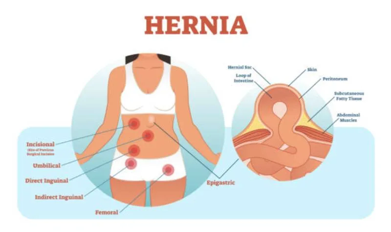 Graphic representation of abdominal wall defects
