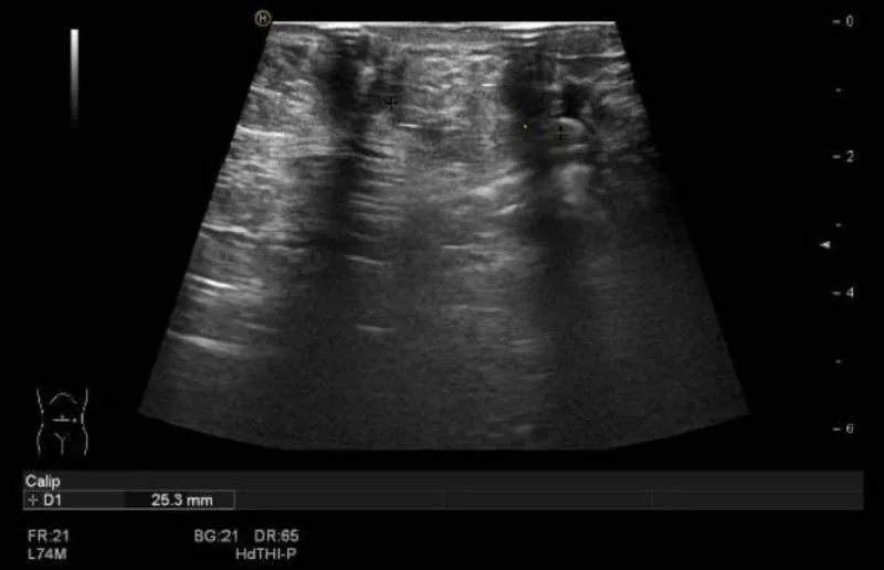 Ultrasound of the abdominal wall in the clinic