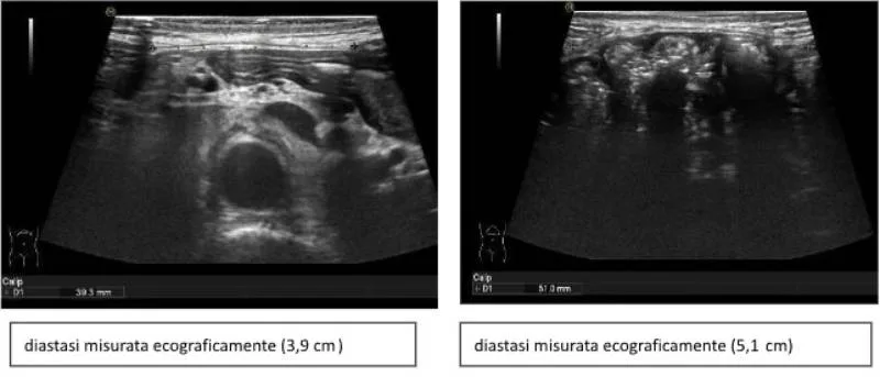 Ultrasound of the abdominal wall in the clinic