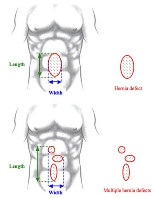 Defects related to abdominal hernias