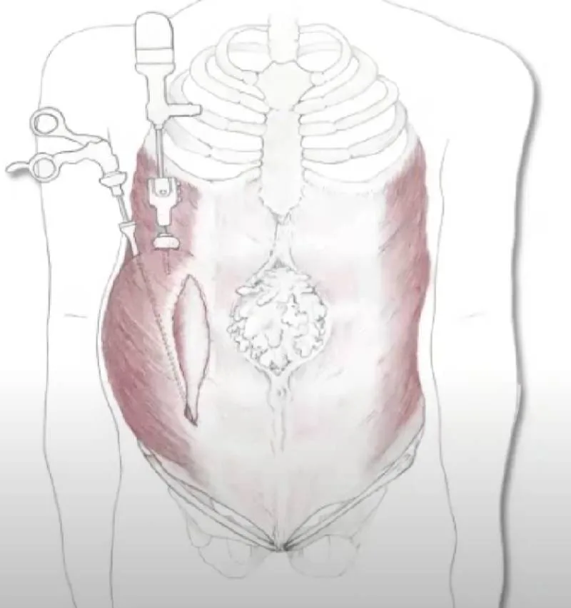 Endoscopic modification of the abdominal component separation