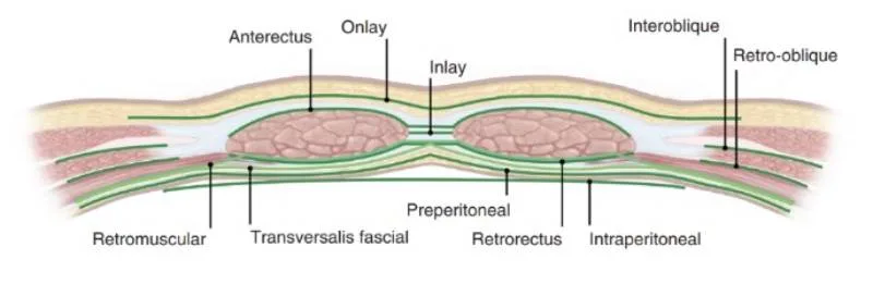 Placement of the mesh in the retromuscular plane
