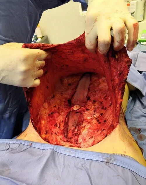 Abdominal scar with skin bridges after wall surgery