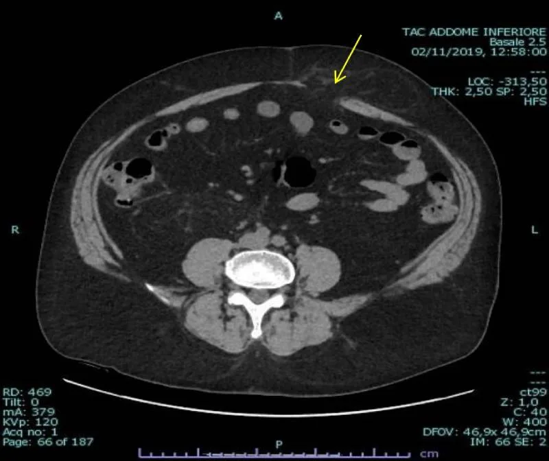 CT of the abdominal wall for the assessment of defects