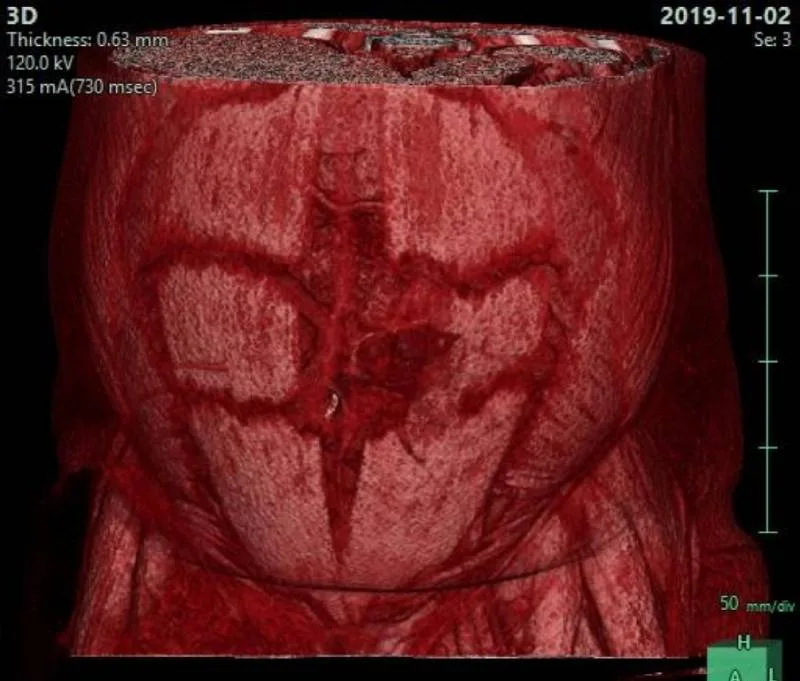 CT of the abdominal wall for the assessment of defects