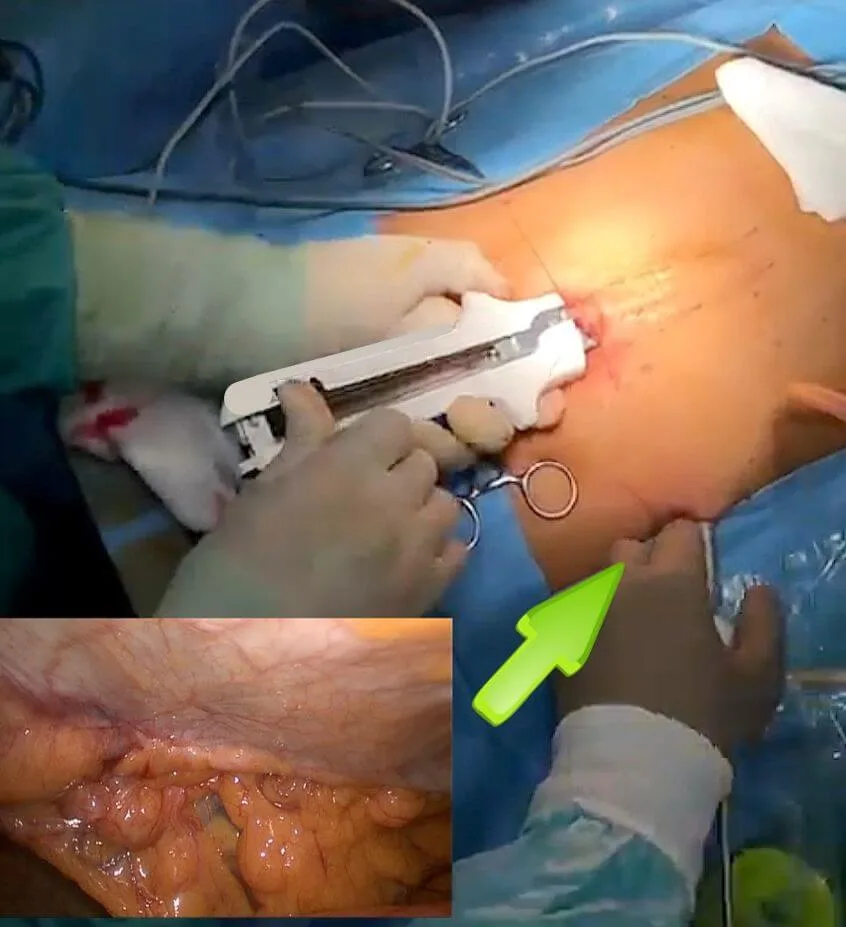Imaging of the abdominal wall before surgery