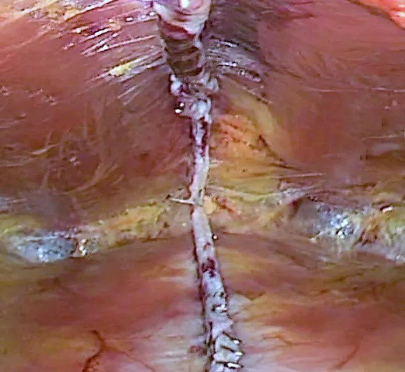 Imaging of the abdominal wall after surgical treatment