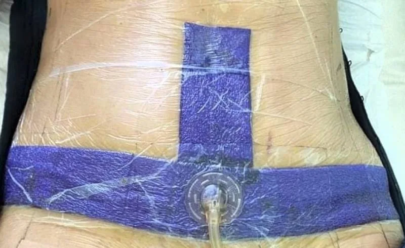 Application of the VAC therapy system for abdominal wound complications